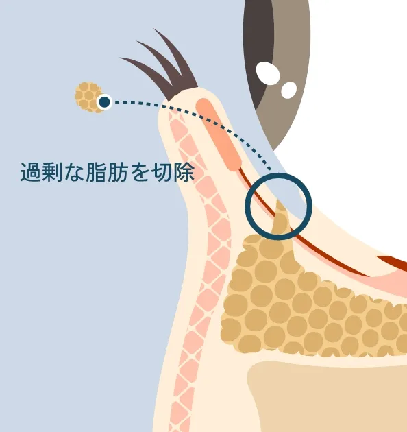 余分な眼窩脂肪を切除している様子