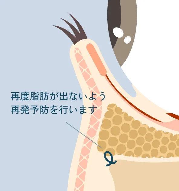 脂肪の再発予防処置を行い、すっきりした状態