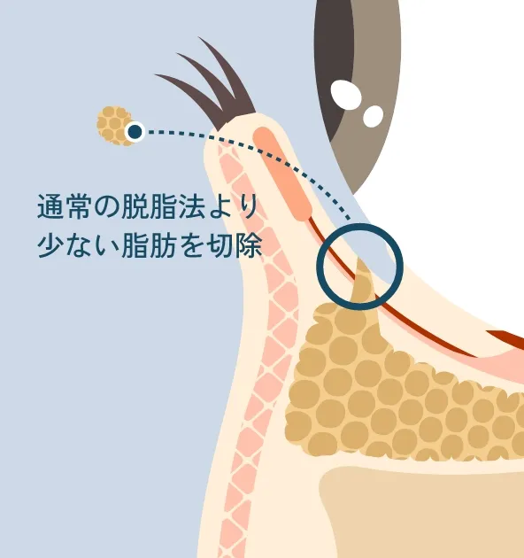 通常の脱脂法より少ない脂肪を切除している様子