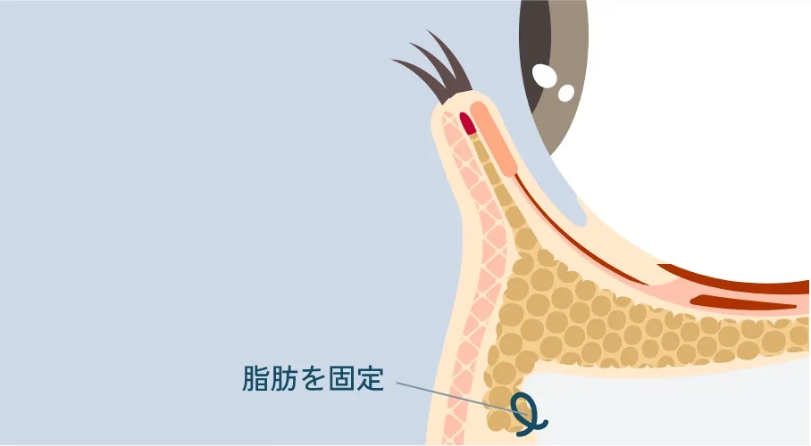 裏ハムラ法の断面図。眼窩脂肪を移動し固定した状態