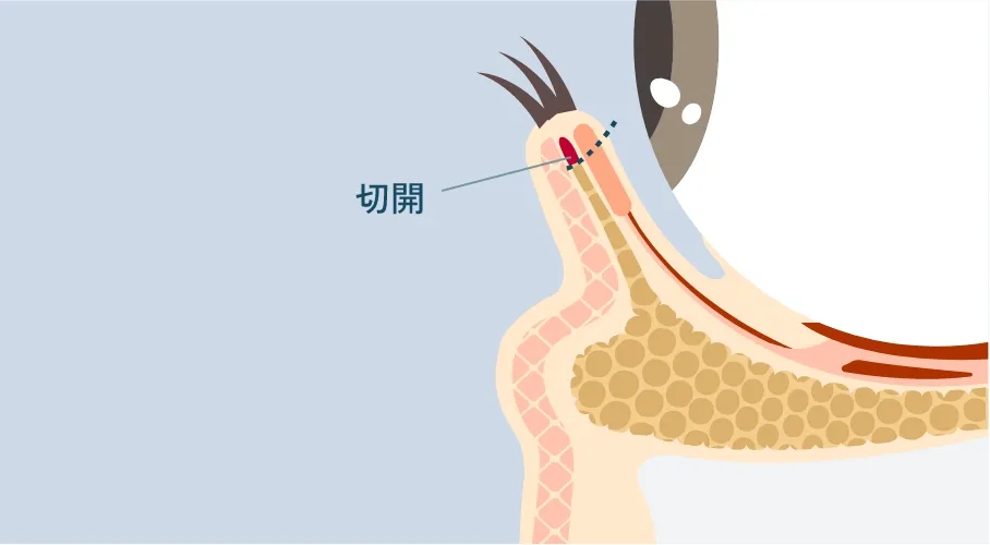 裏ハムラ法の断面図。まぶたの裏側から切開している状態