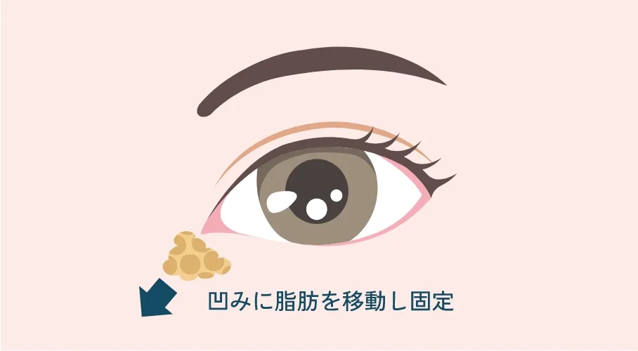 裏ハムラ法の正面図。凹みに脂肪を移動し固定した状態