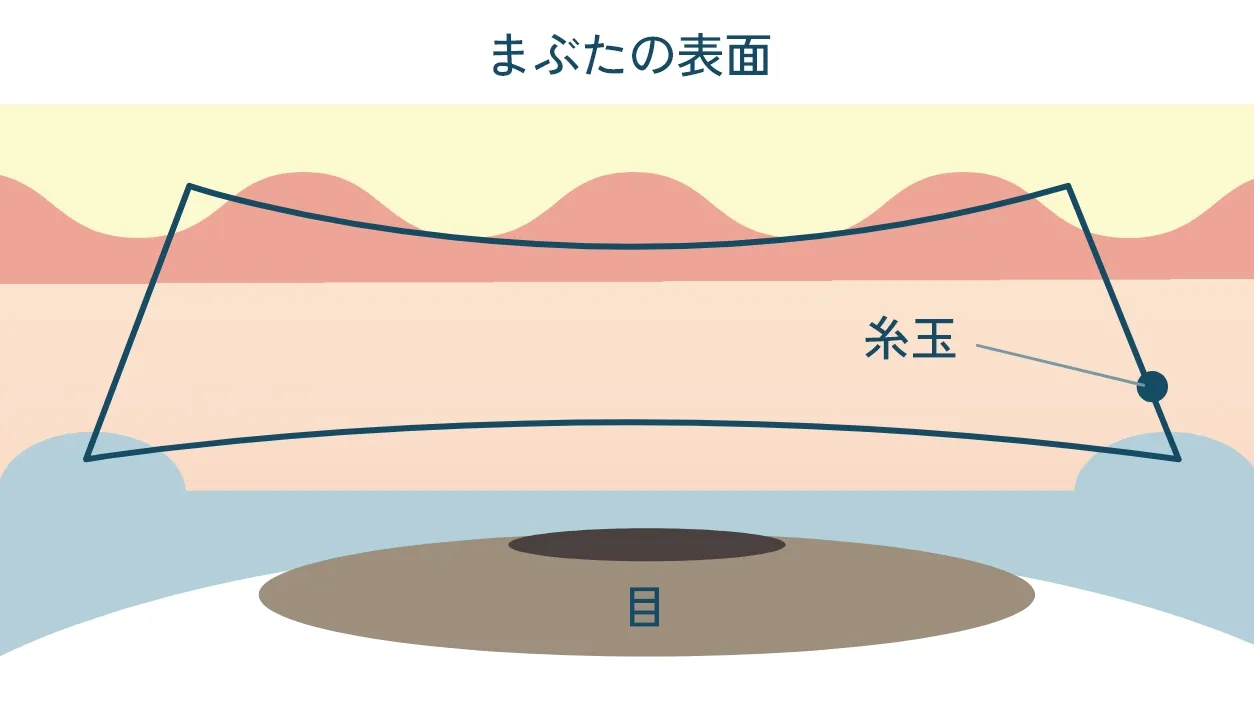 ピンポイント二重術の断面イメージ