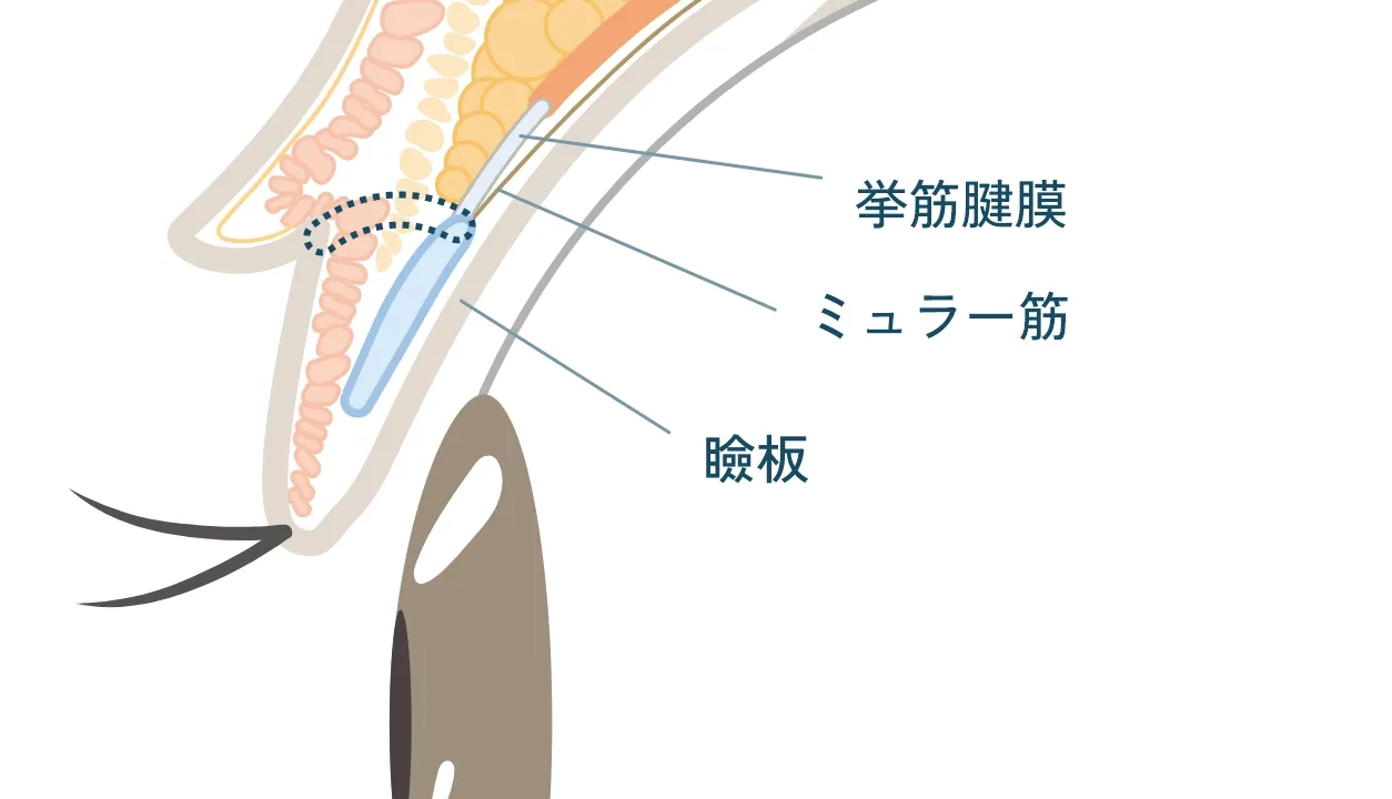 瞼板法の断面イメージ