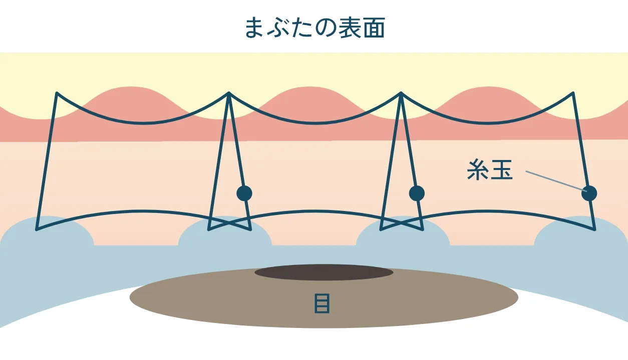 トリプルループ法の断面イメージ