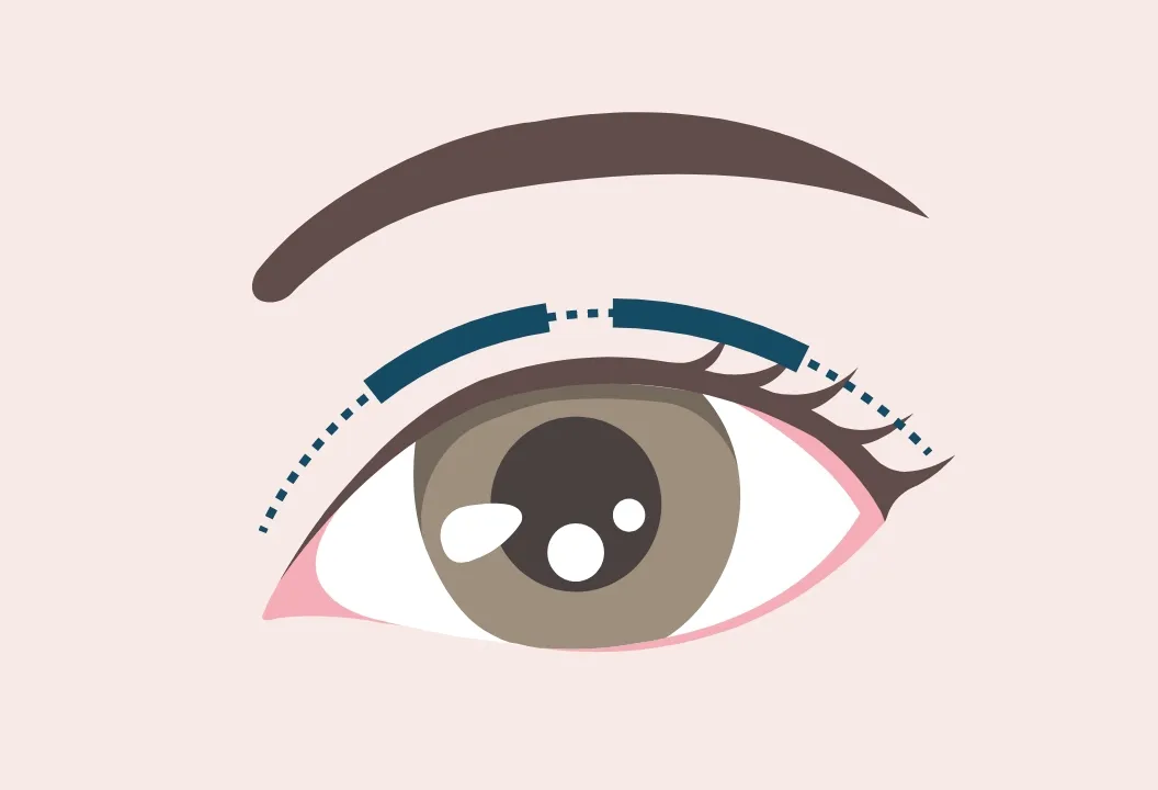 まぶたに糸を通すラインのイメージ