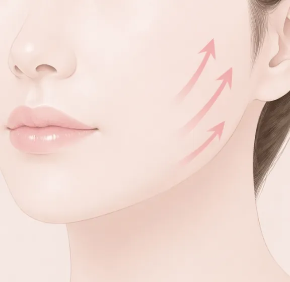 糸で引き上げられた頬のリフトアップ効果を矢印で示しているイラスト