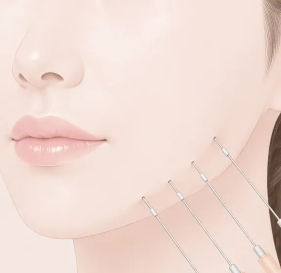 頬に糸リフトの挿入位置と方向を示すラインが描かれたイラスト