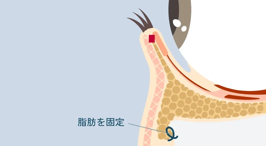 裏ハムラ法の断面図。眼窩脂肪を移動し固定した状態