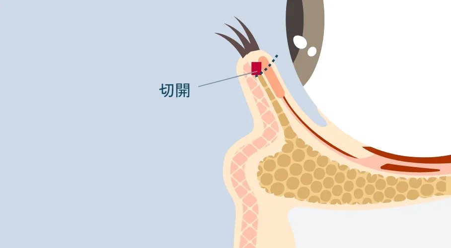 裏ハムラ法の断面図。まぶたの裏側から切開している状態