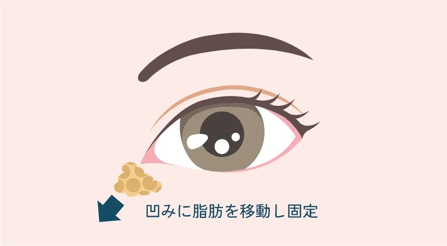 裏ハムラ法の正面図。凹みに脂肪を移動し固定した状態