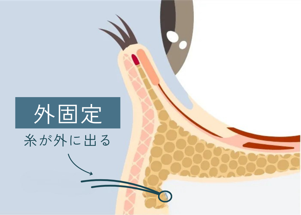 裏ハムラ法の外固定