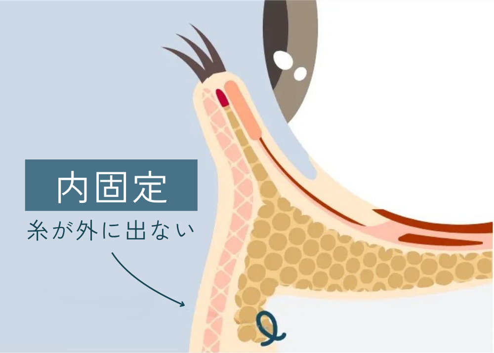 裏ハムラ法の内固定