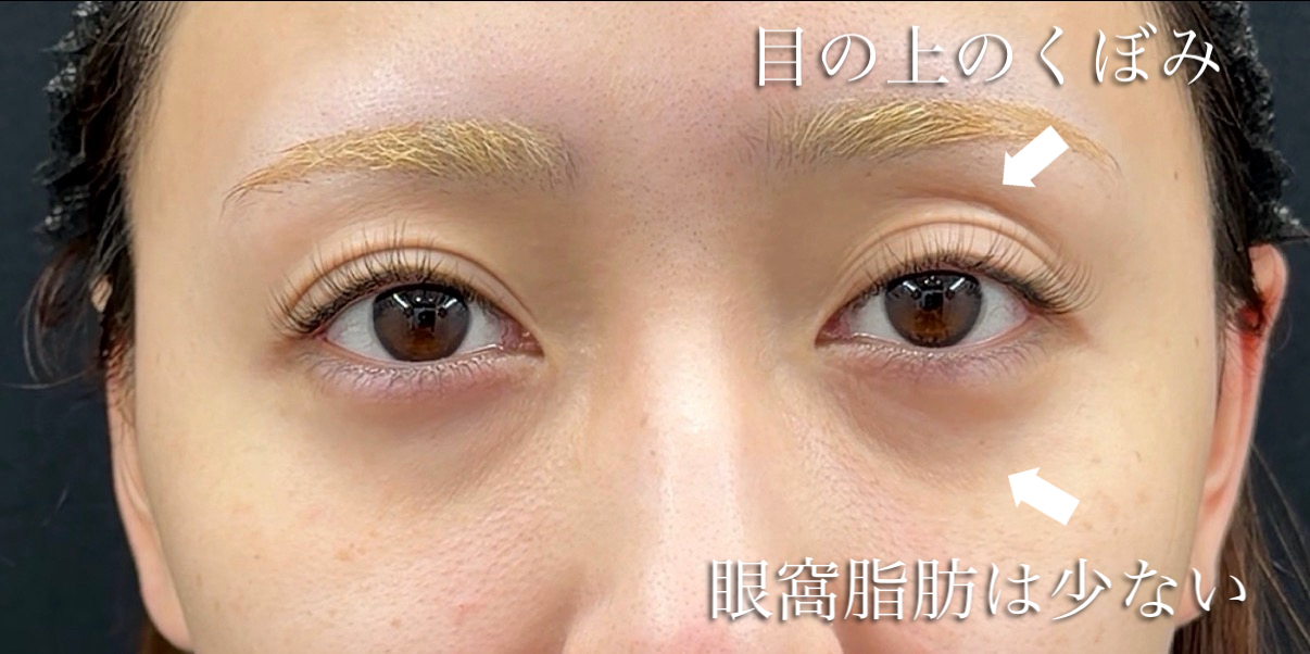 目の下の痩せ・凹みが強い人の写真