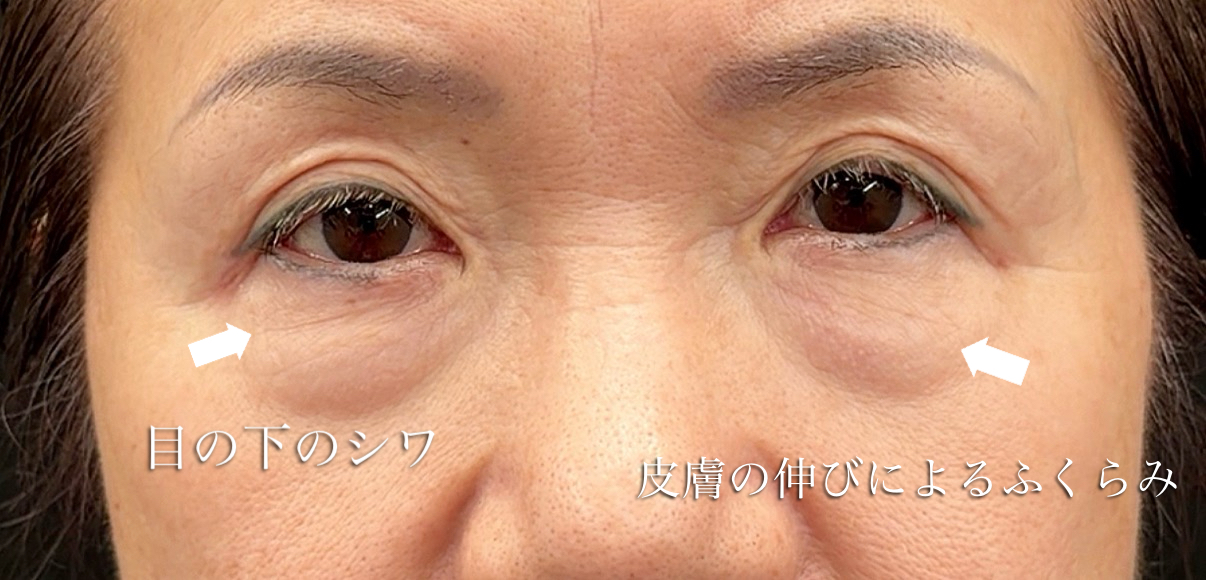 皮膚の伸びやシワが強めにある人の写真