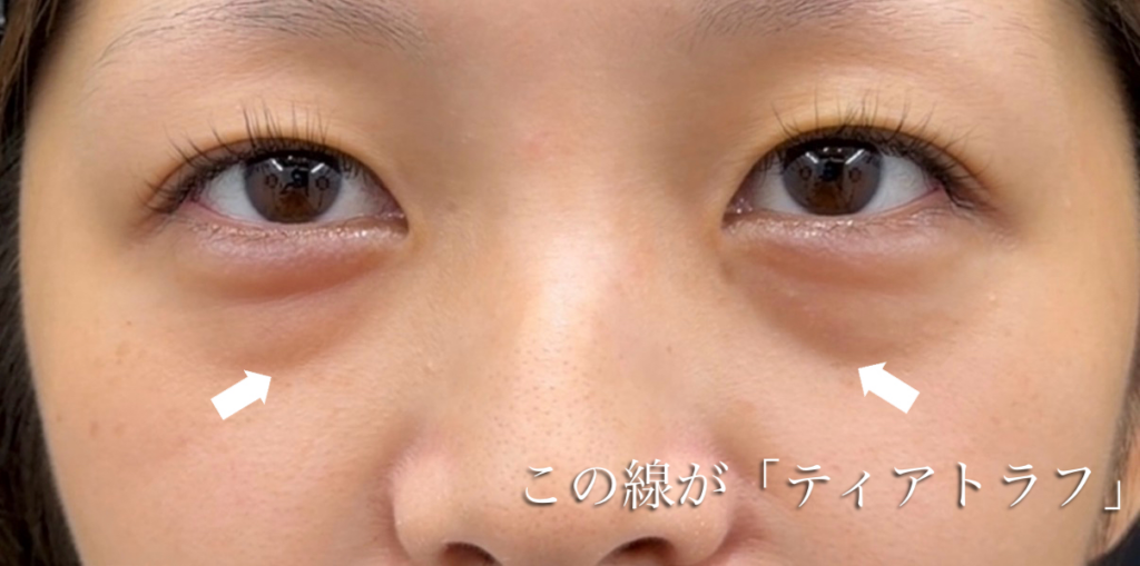 ティアトラフが強い人の写真