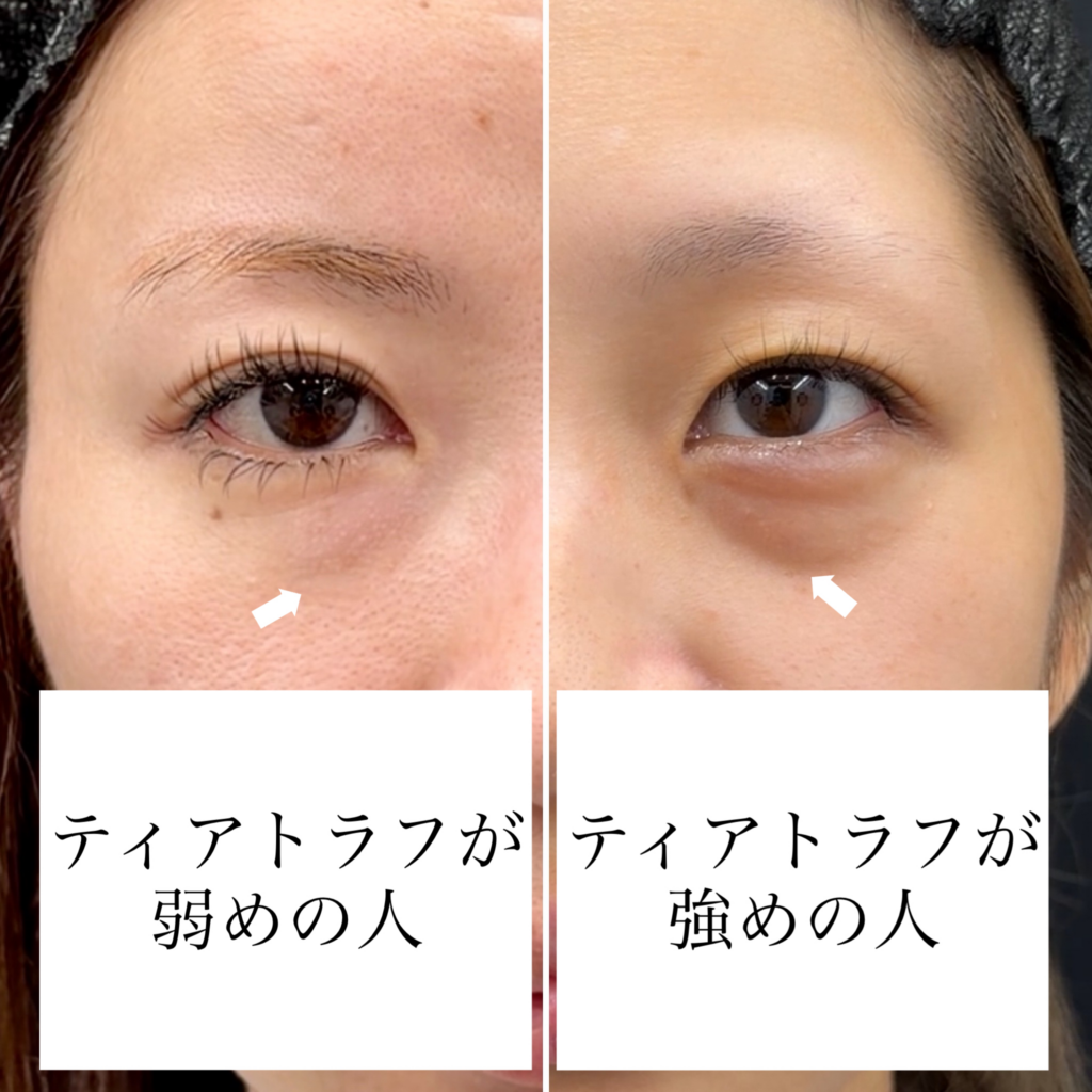 左はティアトラフの線がうすい人、右は線が強い人の写真