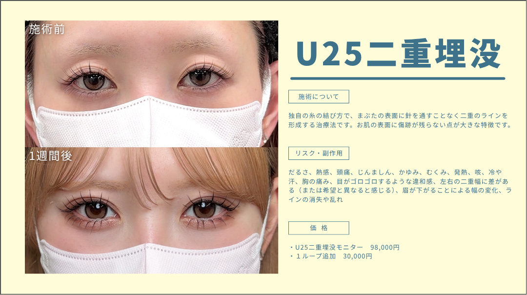 U25二重埋没 症例写真
