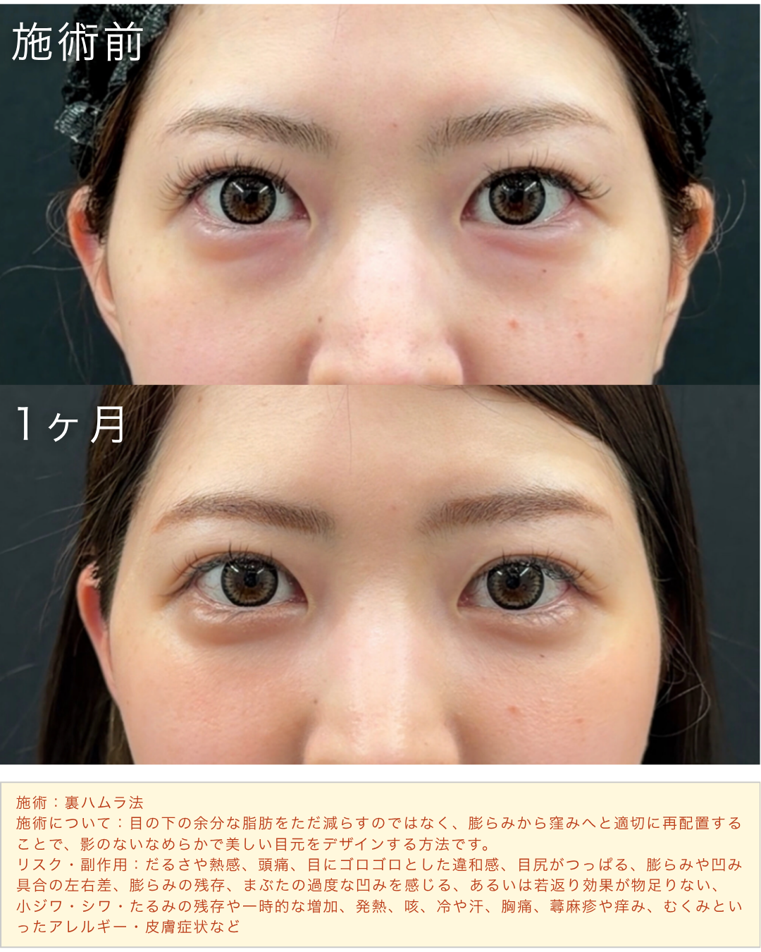 裏ハムラ法症例