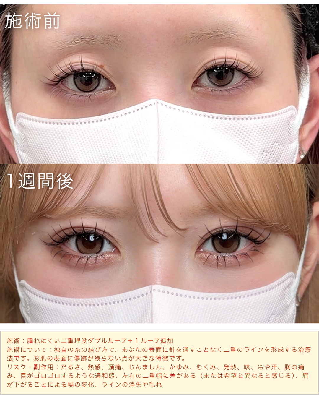 腫れにくい二重埋没症例